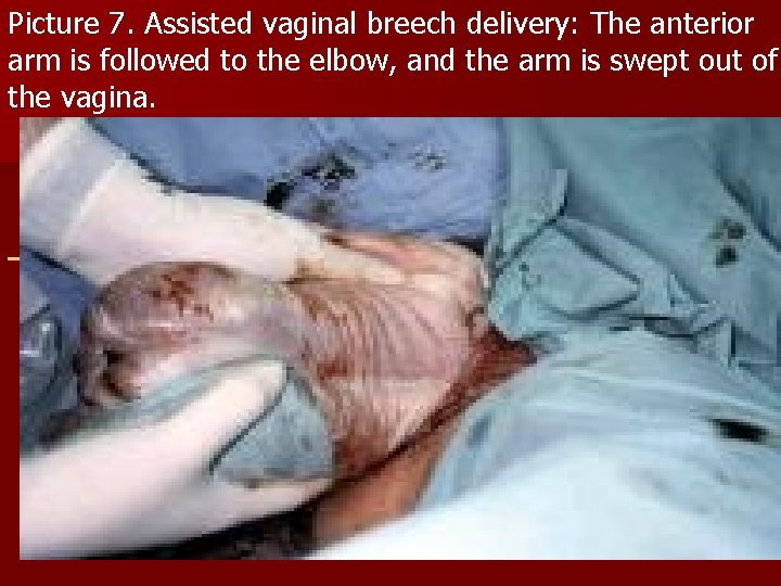 Picture 7. Assisted vaginal breech delivery: The anterior arm is followed to the elbow,