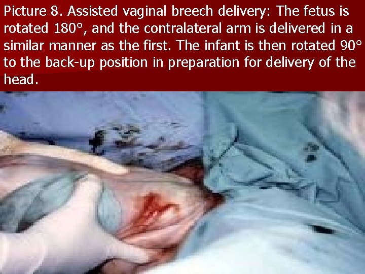 Picture 8. Assisted vaginal breech delivery: The fetus is rotated 180°, and the contralateral