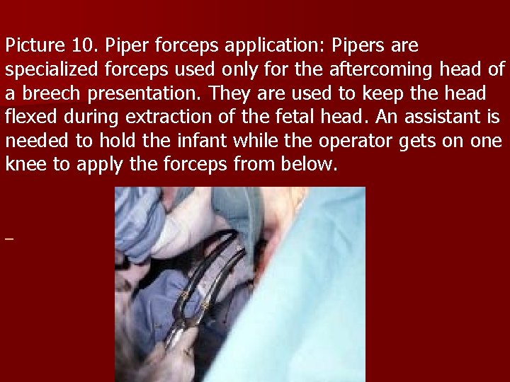 Picture 10. Piper forceps application: Pipers are specialized forceps used only for the aftercoming