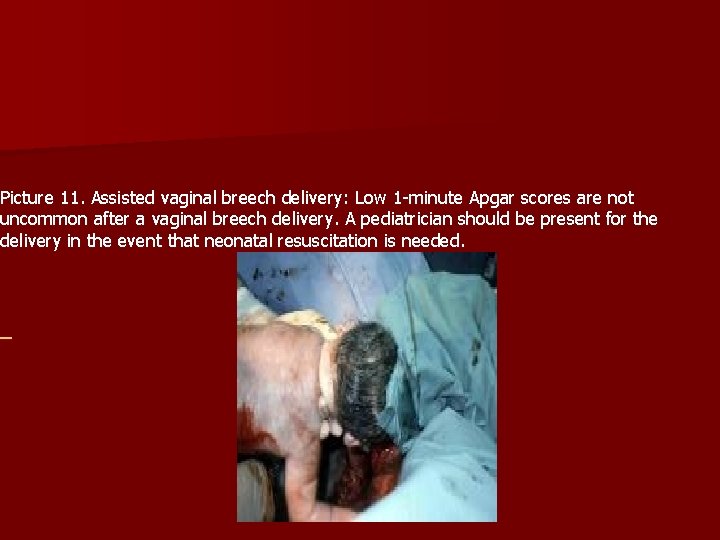 Picture 11. Assisted vaginal breech delivery: Low 1 -minute Apgar scores are not uncommon