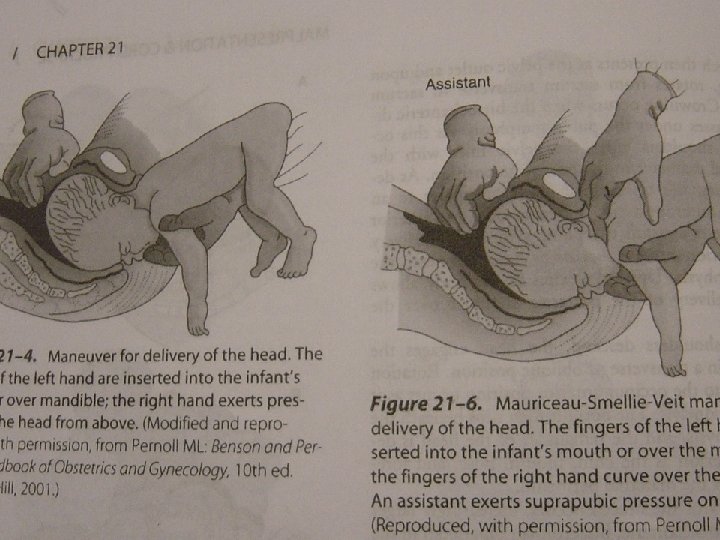 Picture 12. Assisted vaginal breech delivery - The neonate after birth 