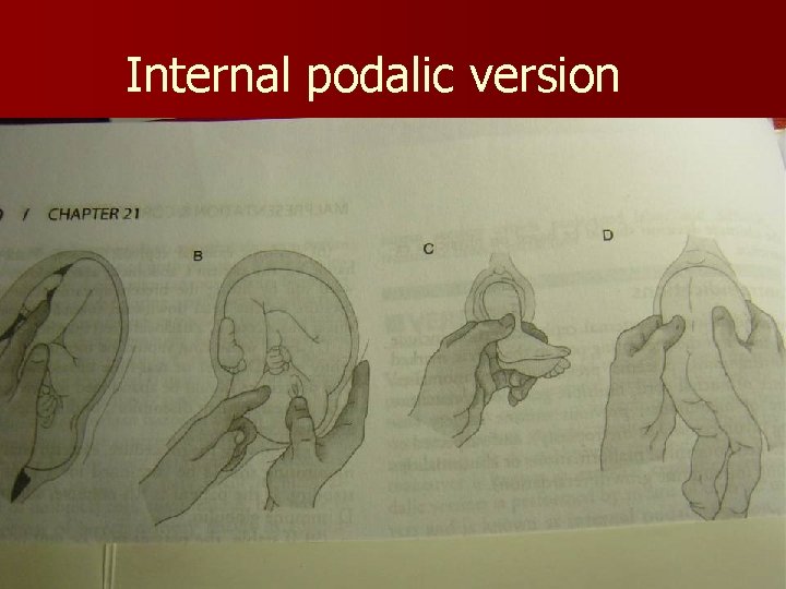 Internal podalic version 