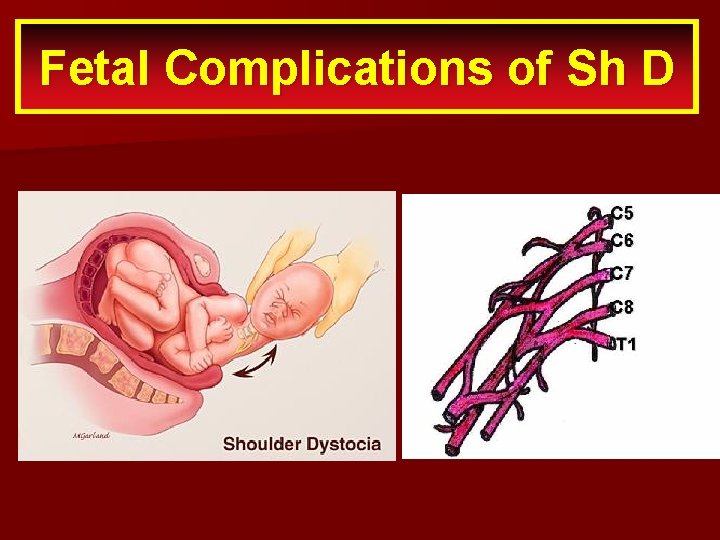 Fetal. Release techniques Complications of Sh D 