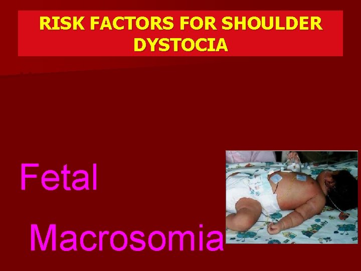RISK FACTORS FOR SHOULDER DYSTOCIA Most of the prenatal and antenatal risk factor are