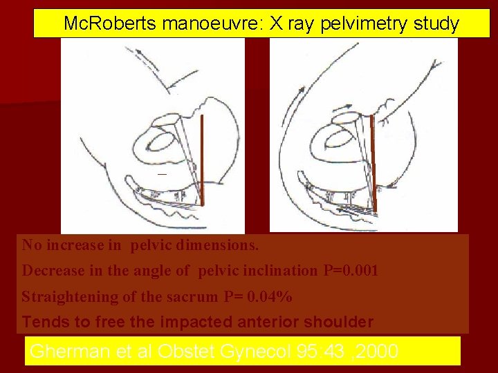 Mc. Roberts manoeuvre: X ray pelvimetry study No increase in pelvic dimensions. Decrease in