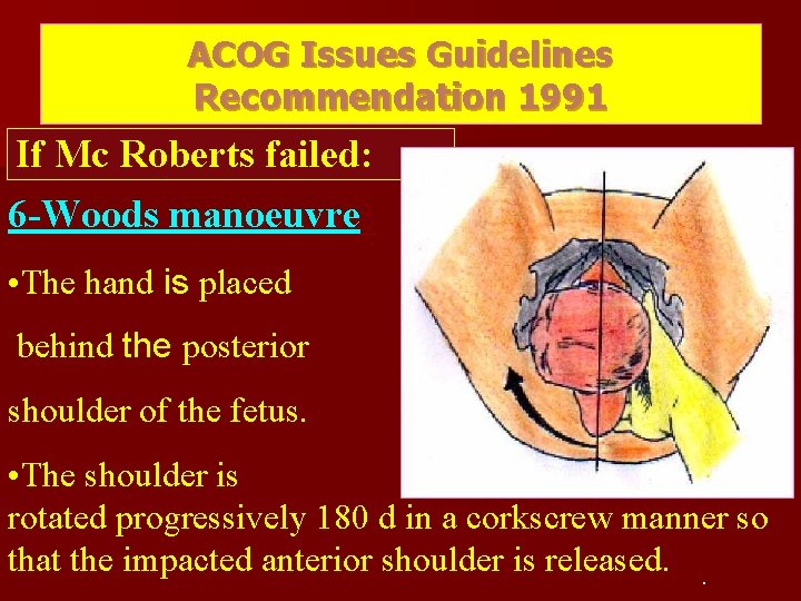ACOG Issues Guidelines Recommendation 1991 If Mc Roberts failed: 6 -Woods manoeuvre: • The