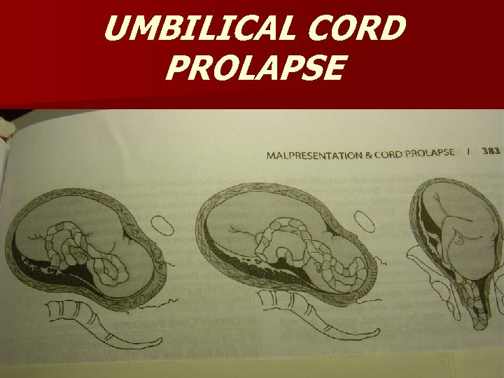 UMBILICAL CORD PROLAPSE 