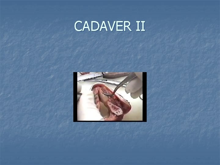 CADAVER II 