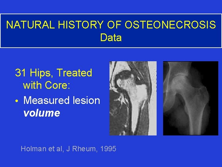 NATURAL HISTORY OF OSTEONECROSIS Data 31 Hips, Treated with Core: • Measured lesion volume