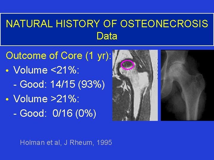 NATURAL HISTORY OF OSTEONECROSIS Data Outcome of Core (1 yr): • Volume <21%: -