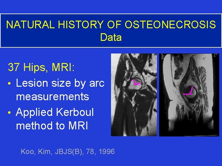 NATURAL HISTORY OF OSTEONECROSIS Data 37 Hips, MRI: • Lesion size by arc measurements