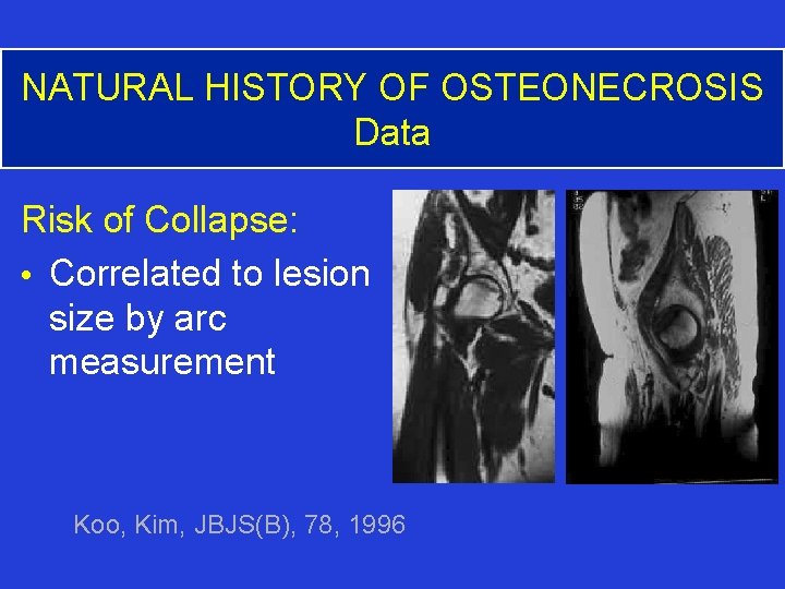 NATURAL HISTORY OF OSTEONECROSIS Data Risk of Collapse: • Correlated to lesion size by