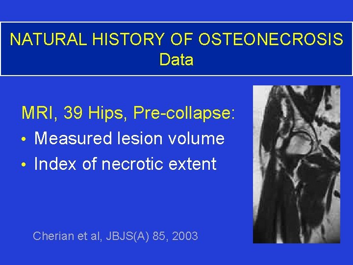 NATURAL HISTORY OF OSTEONECROSIS Data MRI, 39 Hips, Pre-collapse: • Measured lesion volume •