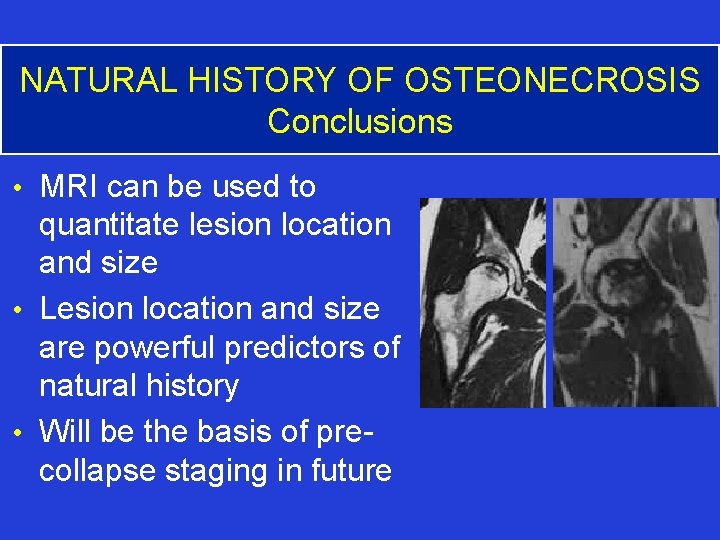 NATURAL HISTORY OF OSTEONECROSIS Conclusions • MRI can be used to quantitate lesion location
