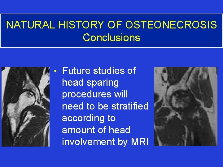 NATURAL HISTORY OF OSTEONECROSIS Conclusions • Future studies of head sparing procedures will need