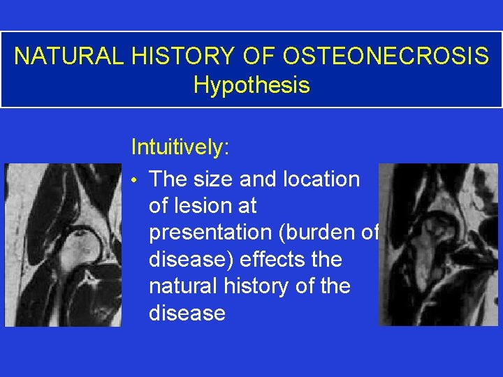 NATURAL HISTORY OF OSTEONECROSIS Hypothesis Intuitively: • The size and location of lesion at
