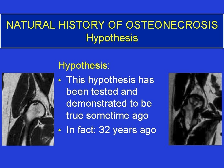 NATURAL HISTORY OF OSTEONECROSIS Hypothesis: • This hypothesis has been tested and demonstrated to