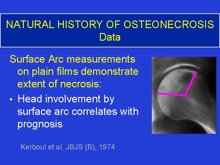 NATURAL HISTORY OF OSTEONECROSIS Data Surface Arc measurements on plain films demonstrate extent of