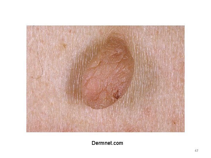 papilloma skin dermnet tratăm helmintiaza