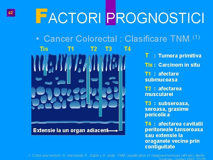 42 FACTORI PROGNOSTICI • Cancer Colorectal : Clasificare TNM (1) Tis T 1 T