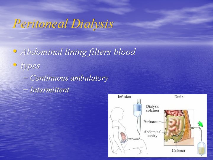 Peritoneal Dialysis • Abdominal lining filters blood • types – Continuous ambulatory – Intermittent