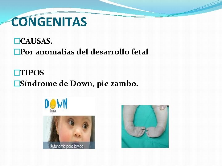 CONGENITAS �CAUSAS. �Por anomalías del desarrollo fetal �TIPOS �Síndrome de Down, pie zambo. CONGENITAS �CAUSAS. �Por anomalías del desarrollo fetal �TIPOS �Síndrome de Down, pie zambo.