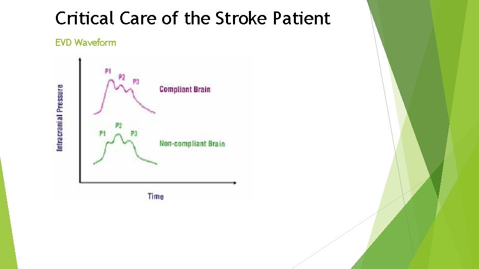 Critical Care of the Stroke Patient EVD Waveform Critical Care of the Stroke Patient EVD Waveform