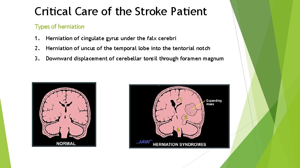 Critical Care of the Stroke Patient Types of herniation 1. Herniation of cingulate gyrus Critical Care of the Stroke Patient Types of herniation 1. Herniation of cingulate gyrus