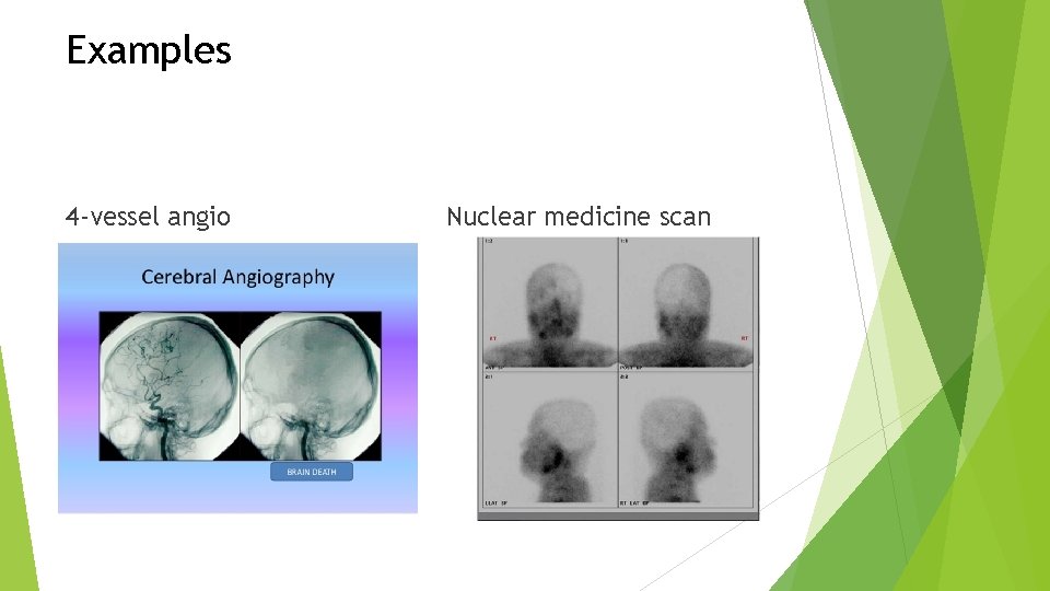 Examples 4 -vessel angio Nuclear medicine scan Examples 4 -vessel angio Nuclear medicine scan