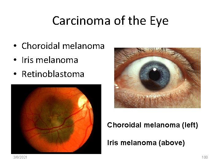 Carcinoma of the Eye • Choroidal melanoma • Iris melanoma • Retinoblastoma Choroidal melanoma