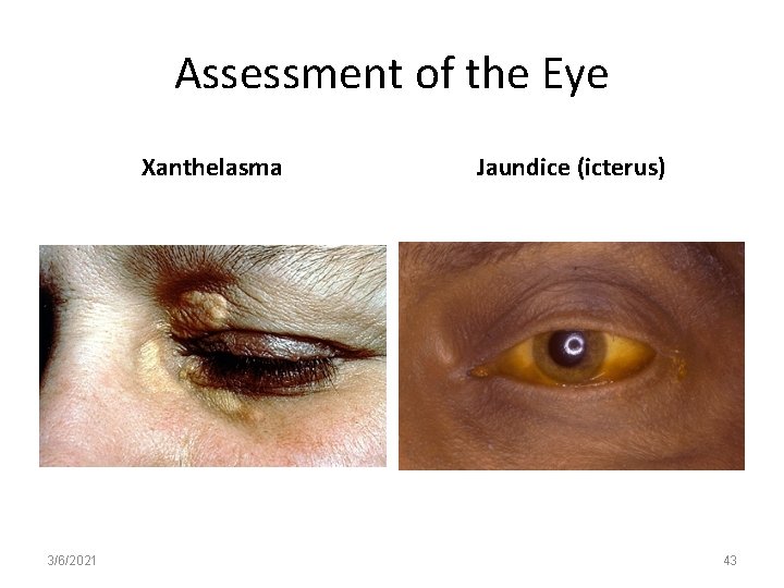 Assessment of the Eye Xanthelasma 3/6/2021 Jaundice (icterus) 43 