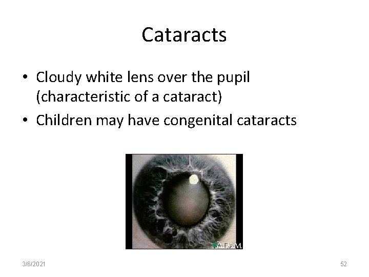 Cataracts • Cloudy white lens over the pupil (characteristic of a cataract) • Children