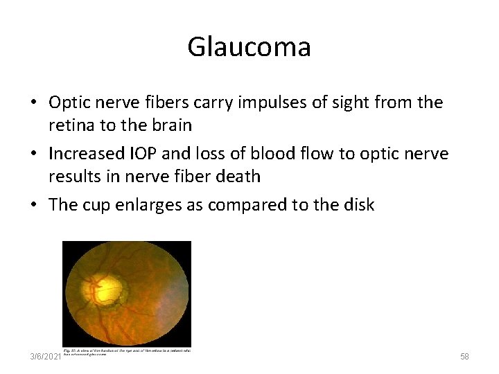 Glaucoma • Optic nerve fibers carry impulses of sight from the retina to the