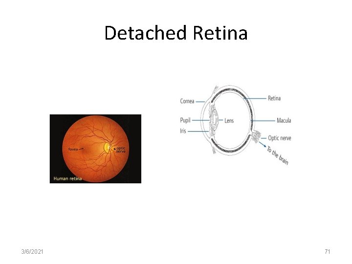 Detached Retina 3/6/2021 71 