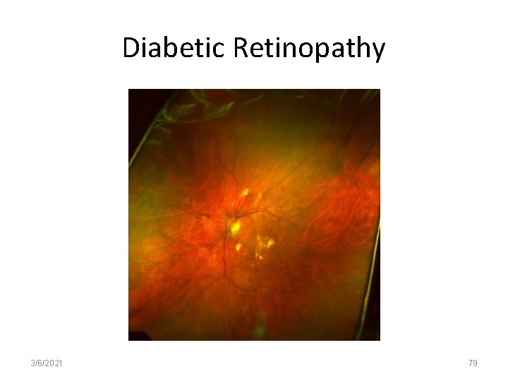 Diabetic Retinopathy 3/6/2021 79 