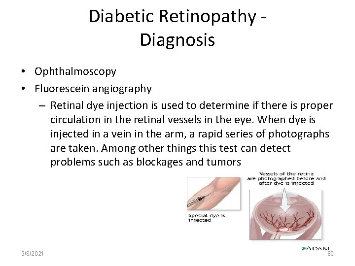 Diabetic Retinopathy Diagnosis • Ophthalmoscopy • Fluorescein angiography – Retinal dye injection is used