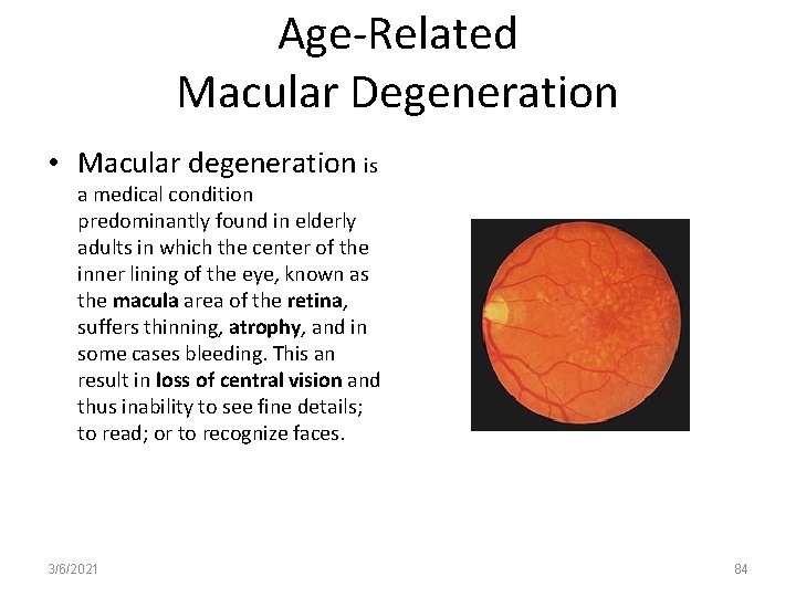 Age-Related Macular Degeneration • Macular degeneration is a medical condition predominantly found in elderly