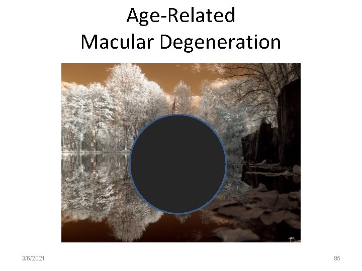 Age-Related Macular Degeneration 3/6/2021 85 