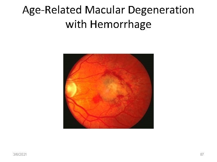 Age-Related Macular Degeneration with Hemorrhage 3/6/2021 87 