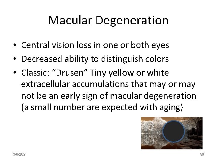 Macular Degeneration • Central vision loss in one or both eyes • Decreased ability