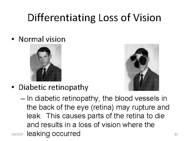 Differentiating Loss of Vision • Normal vision • Diabetic retinopathy – In diabetic retinopathy,