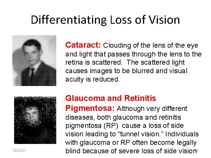 Differentiating Loss of Vision Cataract: Clouding of the lens of the eye and light