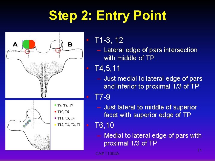 Step 2: Entry Point • T 1 -3, 12 – Lateral edge of pars