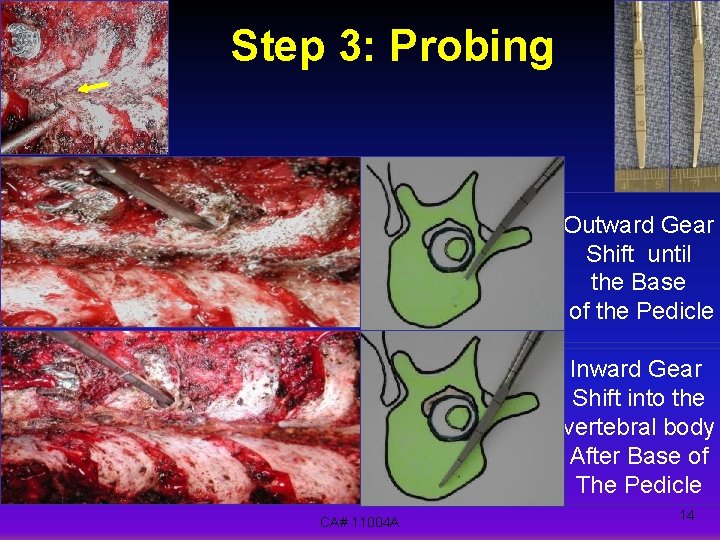 Step 3: Probing Outward Gear Shift until the Base of the Pedicle Inward Gear