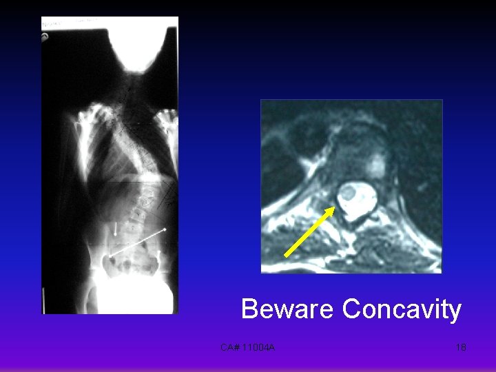 Beware Concavity CA# 11004 A 18 