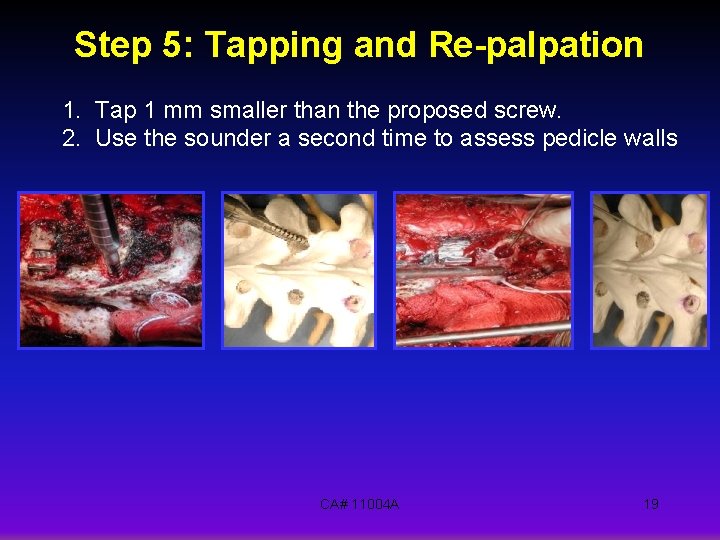 Step 5: Tapping and Re-palpation 1. Tap 1 mm smaller than the proposed screw.