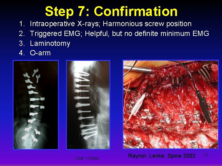 Step 7: Confirmation 1. 2. 3. 4. Intraoperative X-rays; Harmonious screw position Triggered EMG;