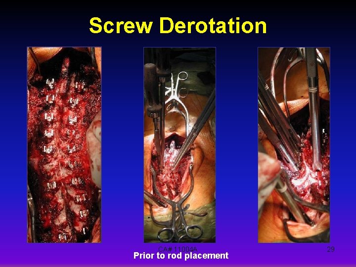 Screw Derotation CA# 11004 A Prior to rod placement 29 