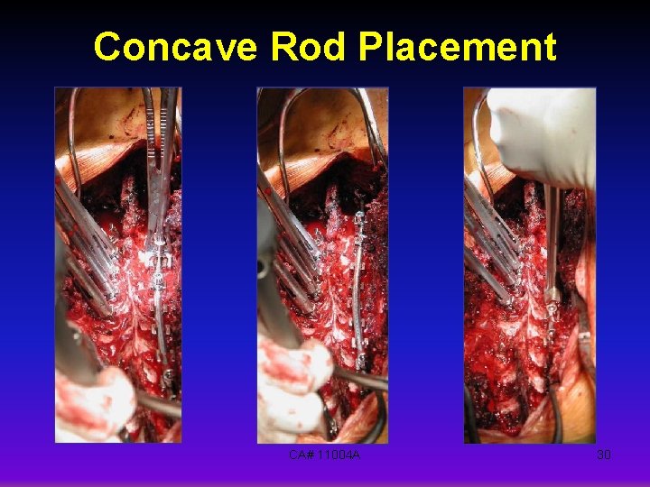 Concave Rod Placement CA# 11004 A 30 