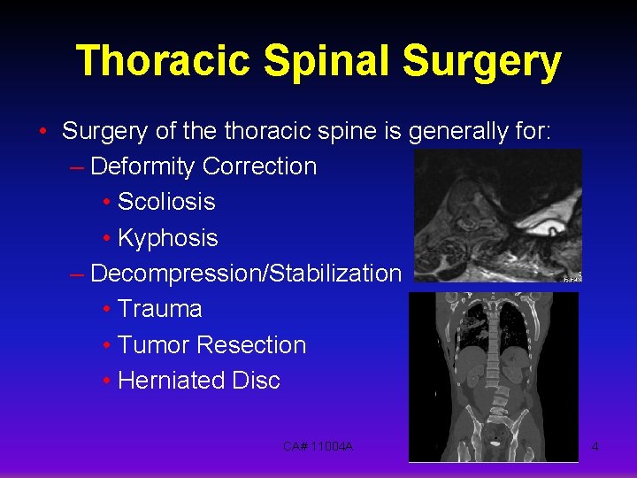 Thoracic Spinal Surgery • Surgery of the thoracic spine is generally for: – Deformity